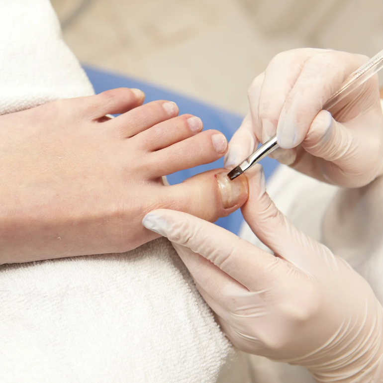 Nagelreparatie en -Regulatie Teennagels met Gel